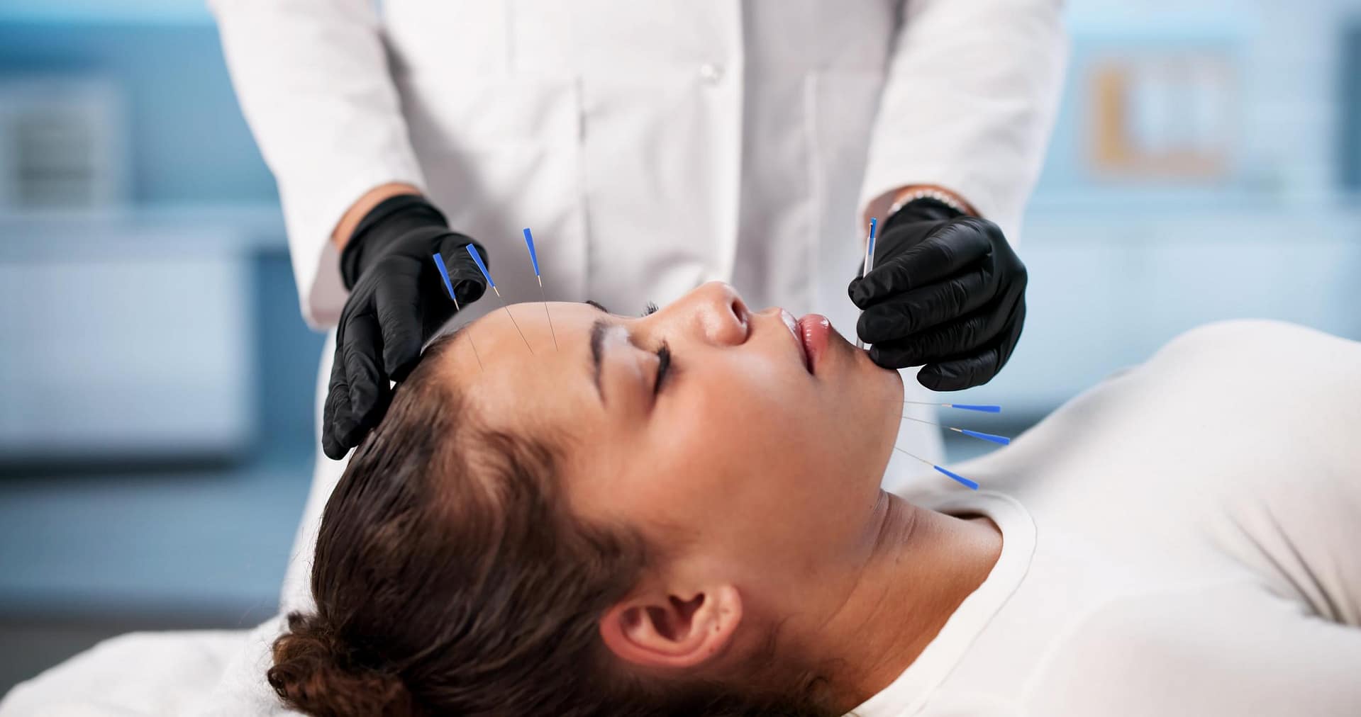 Facial Acupuncture: Where Natural Beauty Meets Whole-Body Wellness