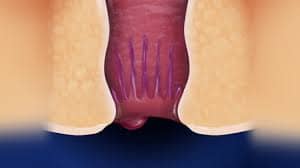 Symptoms of Piles And What They Mean