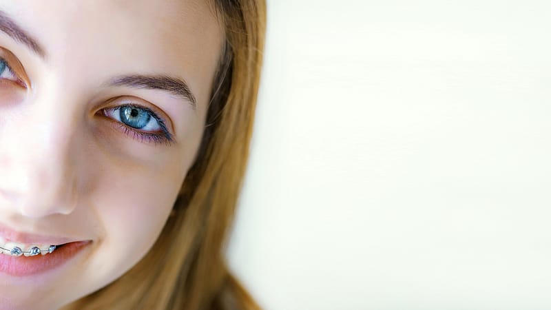 Dental Braces To Consider If You’re Considering A Teeth Change