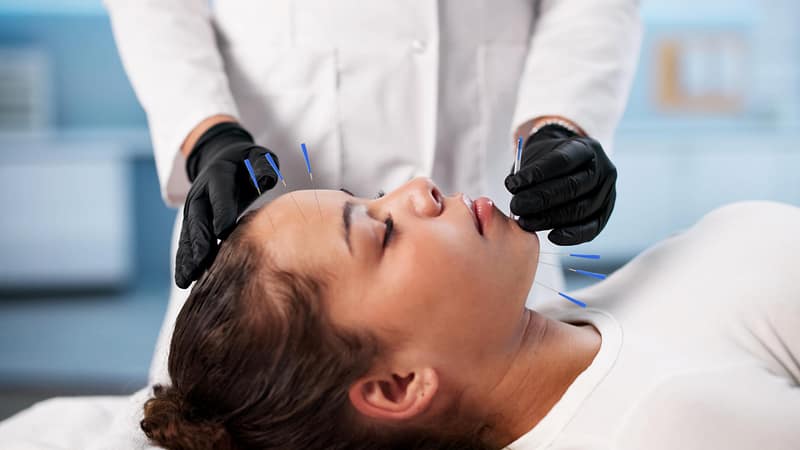 Facial Acupuncture: Where Natural Beauty Meets Whole-Body Wellness